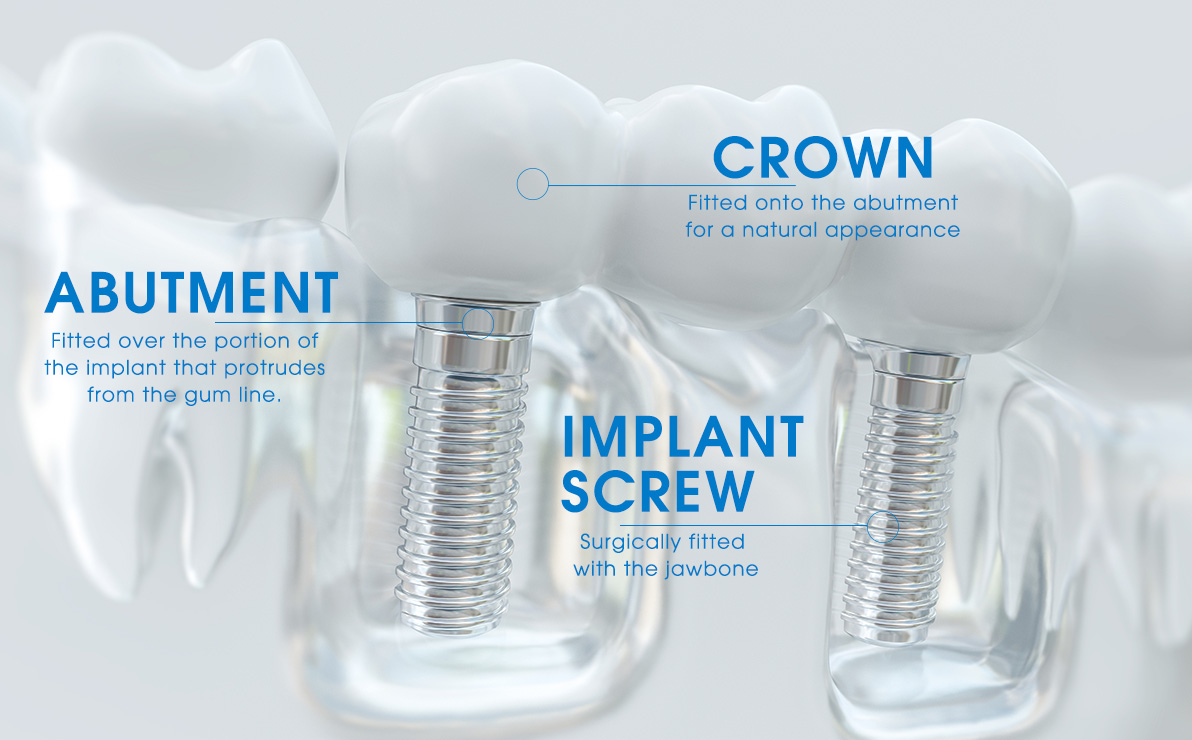 implant parts image